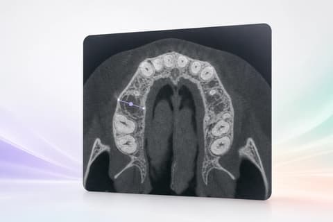 Corte axial CBCT editorial con una sola línea de medición cerca del sitio FDI 14