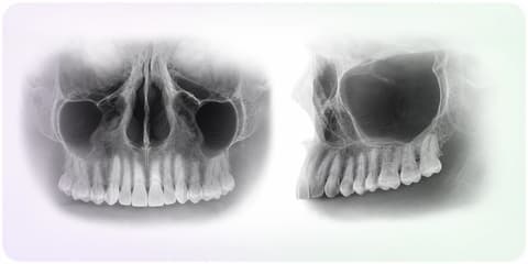 Proyecciones editoriales MIP frontal y lateral del mismo volumen dental