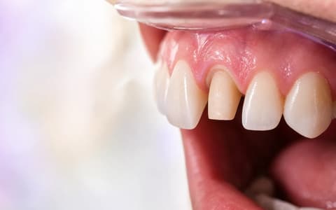 Fotografía clínica sintética del diente 11 con una pregunta del laboratorio anclada al margen distal