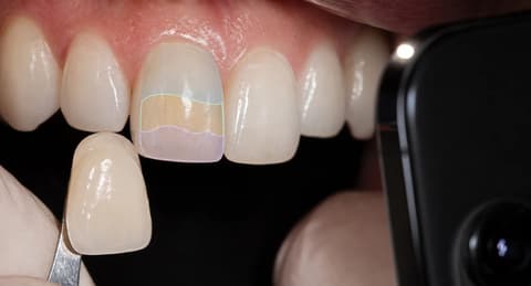TrazaTono conservando referencias incisal, cuerpo y cervical junto a una guía de tono