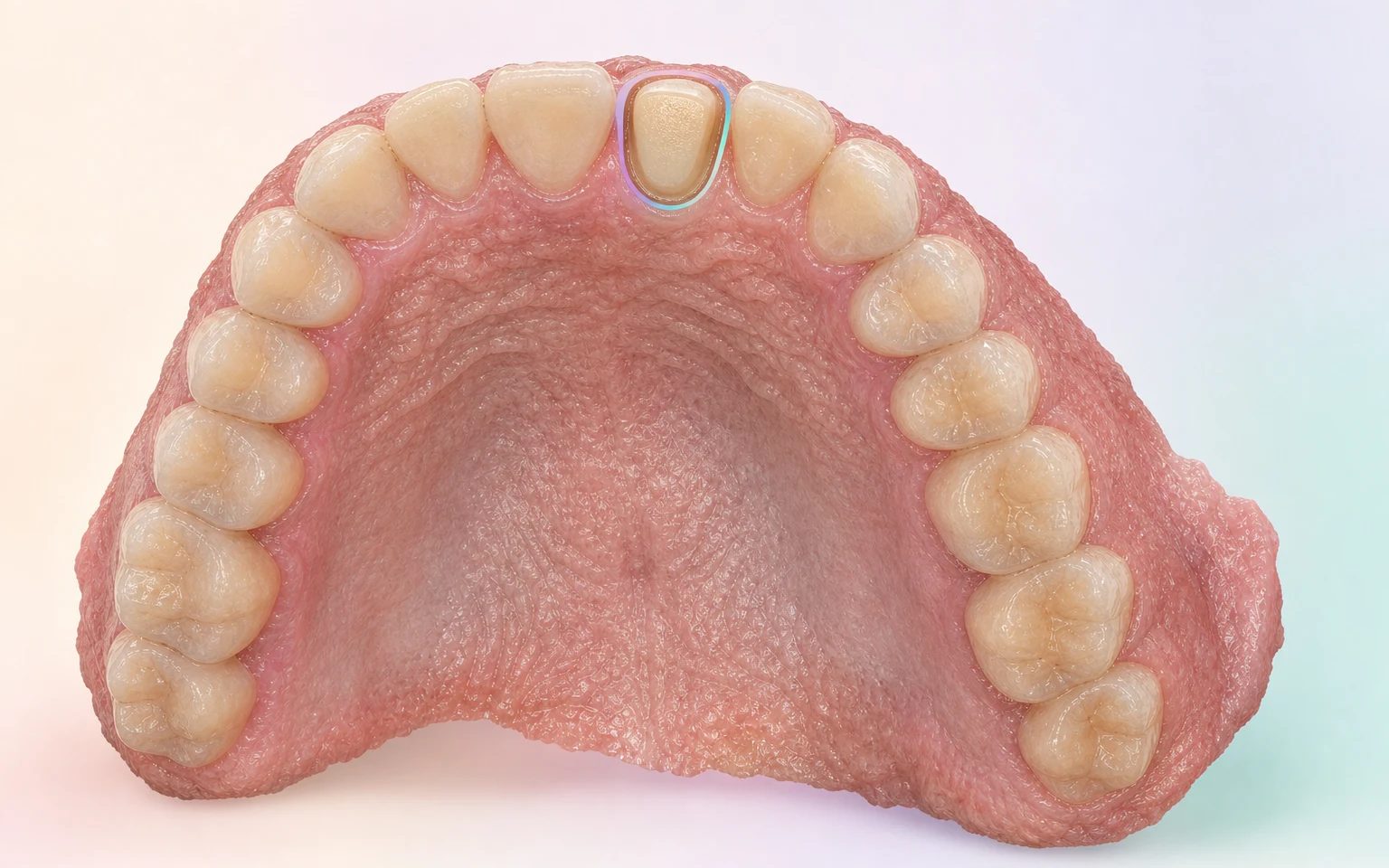 Escaneo intraoral sintético del arco maxilar de trabajo con la preparación dentosoportada FDI 11