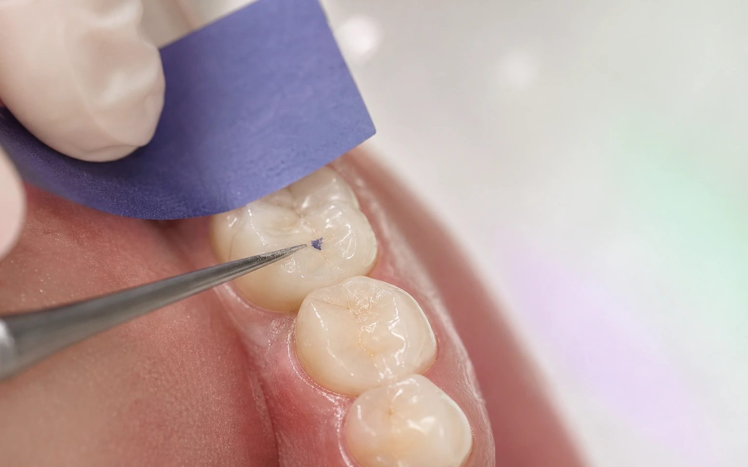 Clinical verification of an occlusal contact with articulating paper and an instrument before deciding the outcome