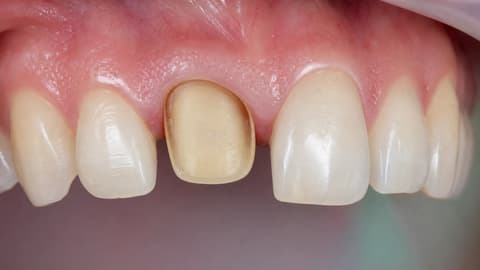 Synthetic anterior preparation with visible margin and tissue