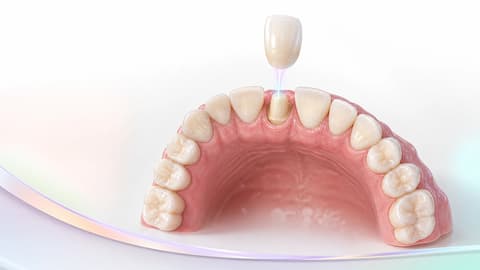 Synthetic upper arch with a crown aligned over the FDI 11 preparation