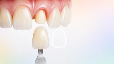 Synthetic shade reference shown next to the anterior site before send