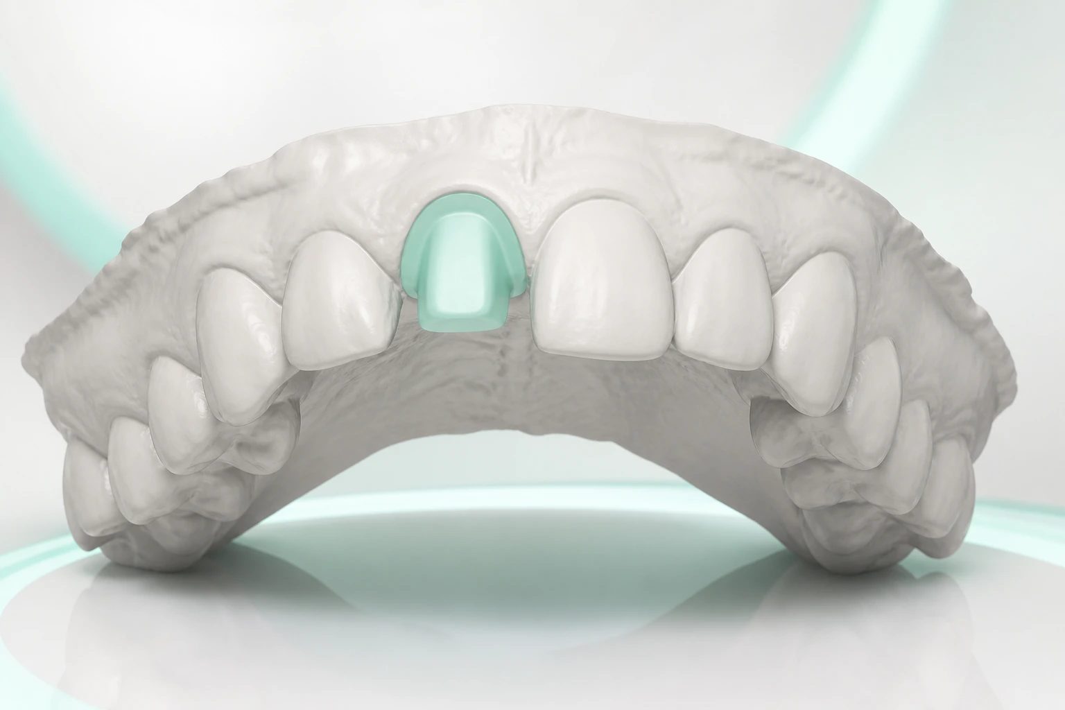 Editorial visualization of a received maxillary scan with the FDI 11 preparation highlighted