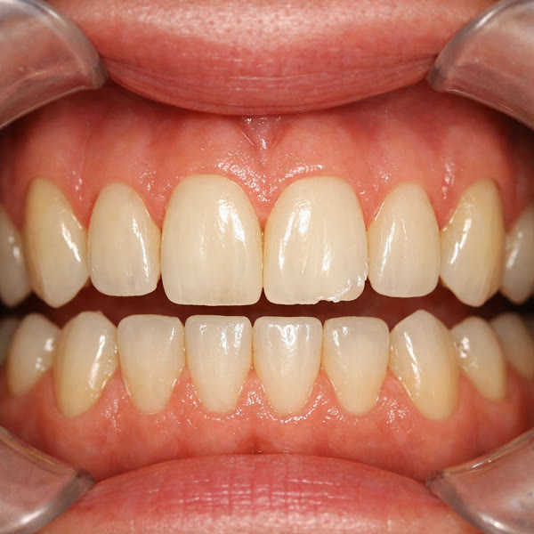 Vista anterior retraída pre-op