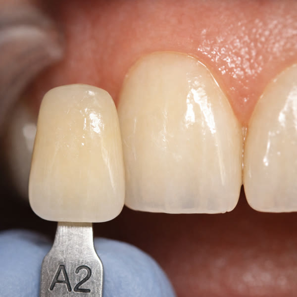 Referencia de tono VITA A2