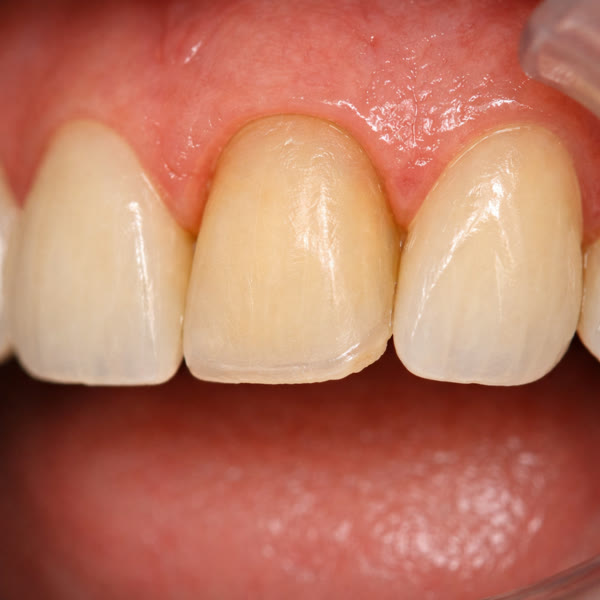 Preparación vista facial