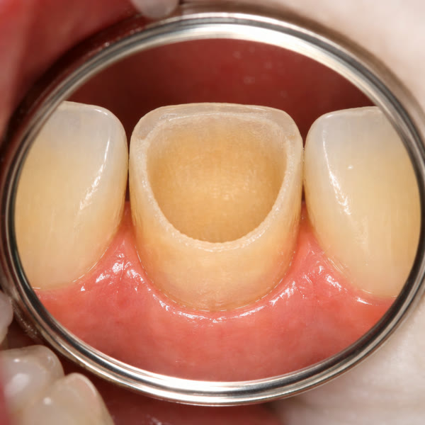 Preparación vista oclusal por espejo