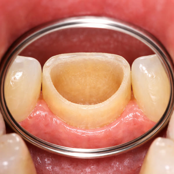 Preparación vista palatina por espejo