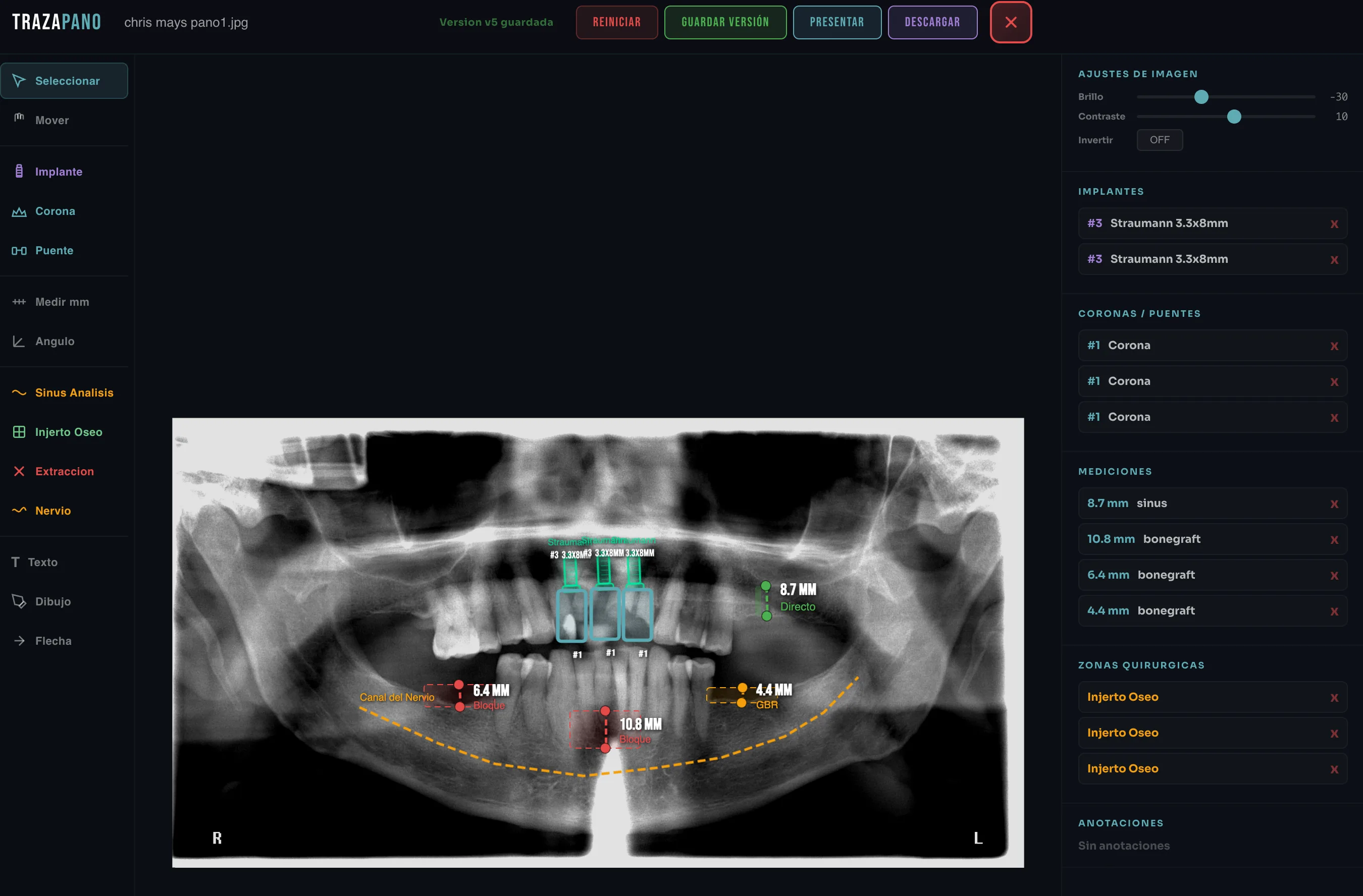 TrazaPano — Interfaz de planificacion quirurgica sobre panoramica dental con implantes Straumann, mediciones de seno maxilar, canal del nervio y zonas de injerto oseo