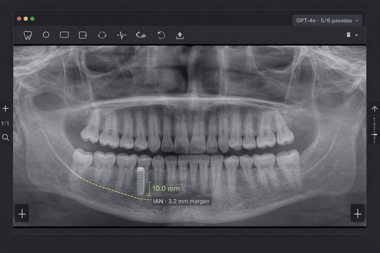TrazaPano — Planificación quirúrgica sobre panorámica dental con implante virtual, nervio alveolar trazado y medición en milímetros