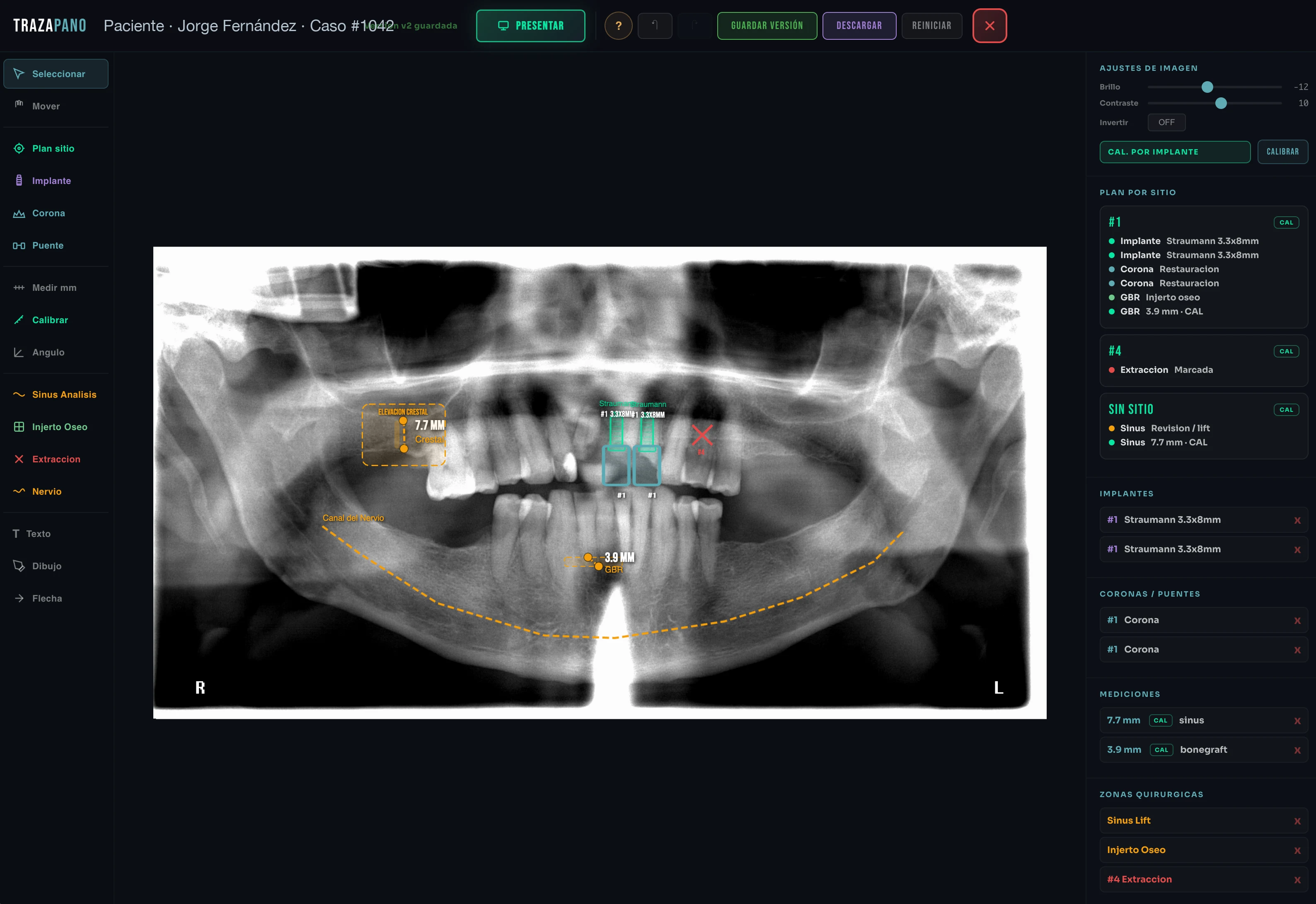 TrazaPano — Caso #1042 Jorge Fernández. Plan: 2 implantes Straumann 3.3×8 mm, sinus lift 7.7 mm, injerto óseo GBR 3.9 mm, extracción #4 marcada, nervio alveolar trazado.
