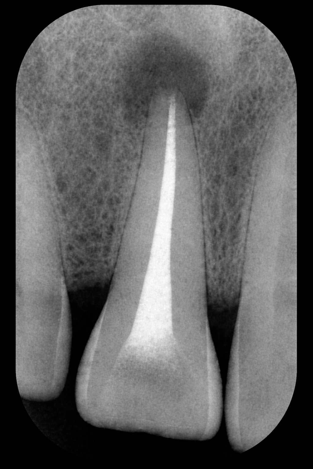 Periapical tooth 22 · control 6 meses · lesión reducida 42%