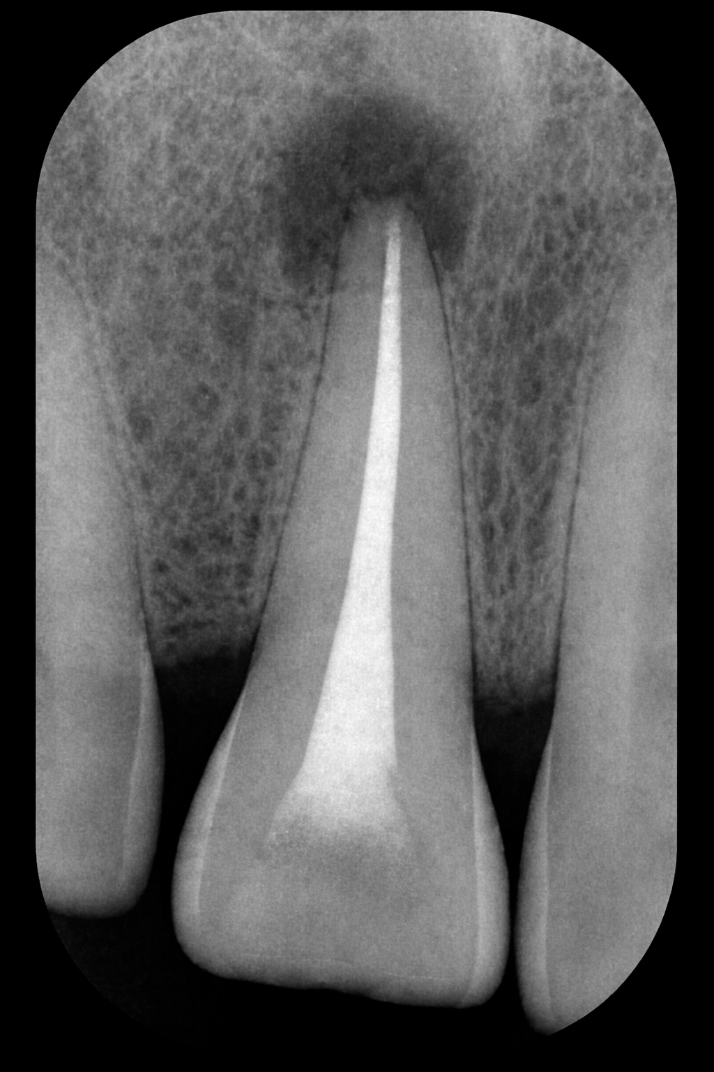 Periapical tooth 22 · post-endodoncia con gutapercha sellada