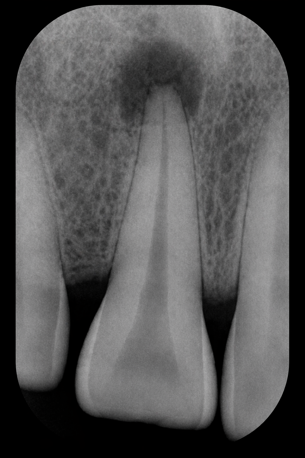 Periapical tooth 22 · diagnóstico inicial · pre-tratamiento