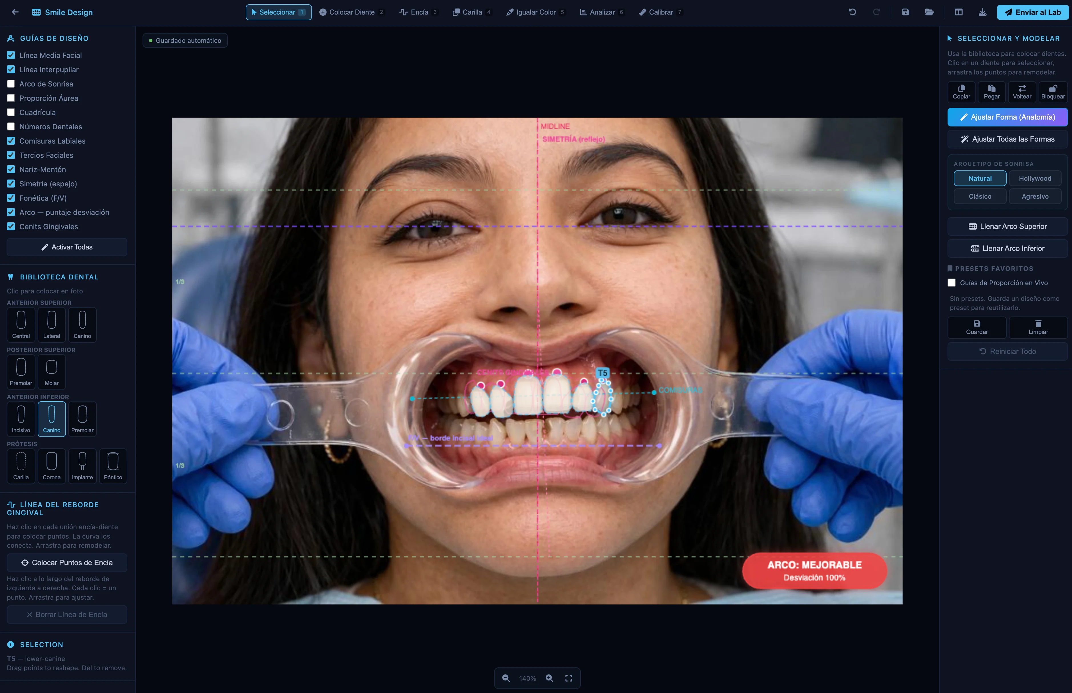 TrazaSonrisa — análisis de sonrisa con línea media facial, plano interpupilar, proporción áurea y biblioteca dental. Aviso: arco mejorable — desviación 100%.