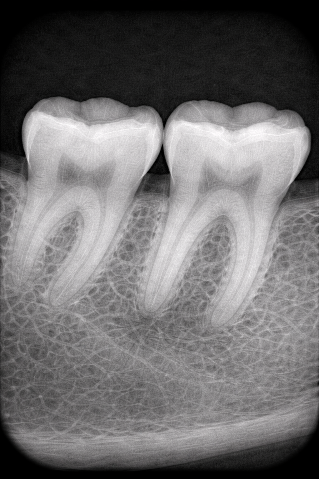 CLAHE enhanced radiograph