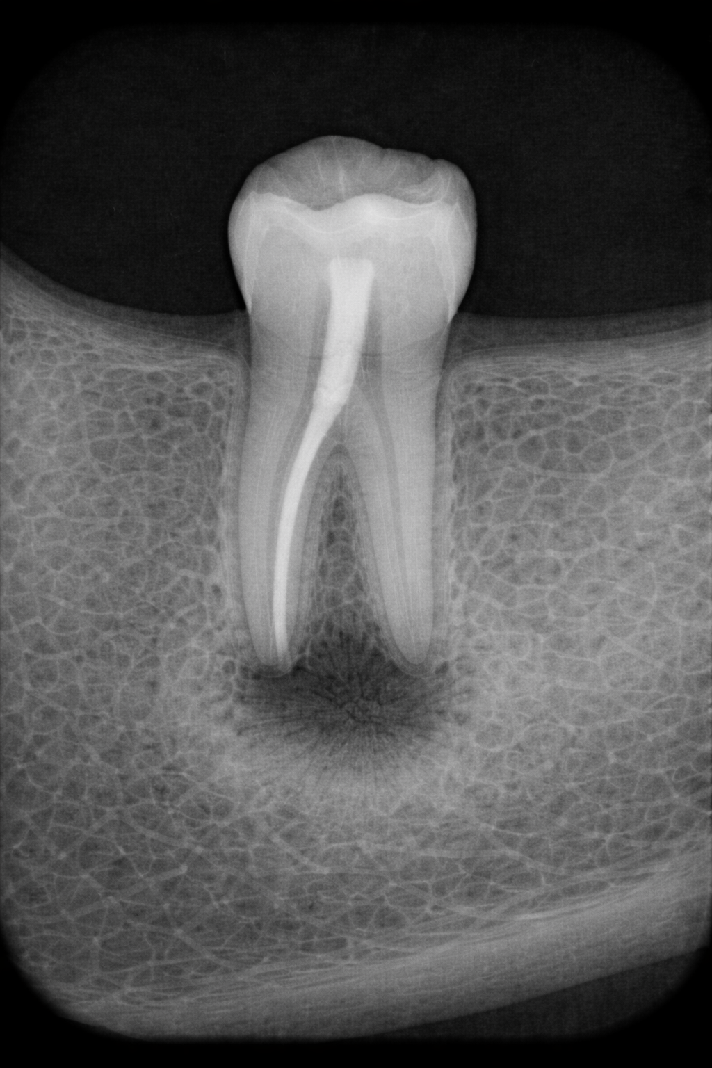 Periapical despues