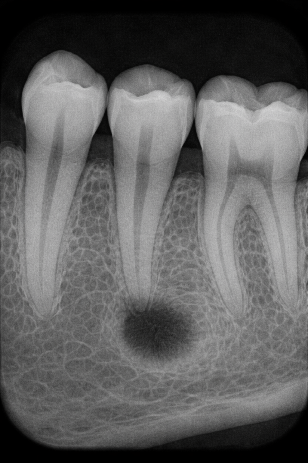 Periapical radiograph
