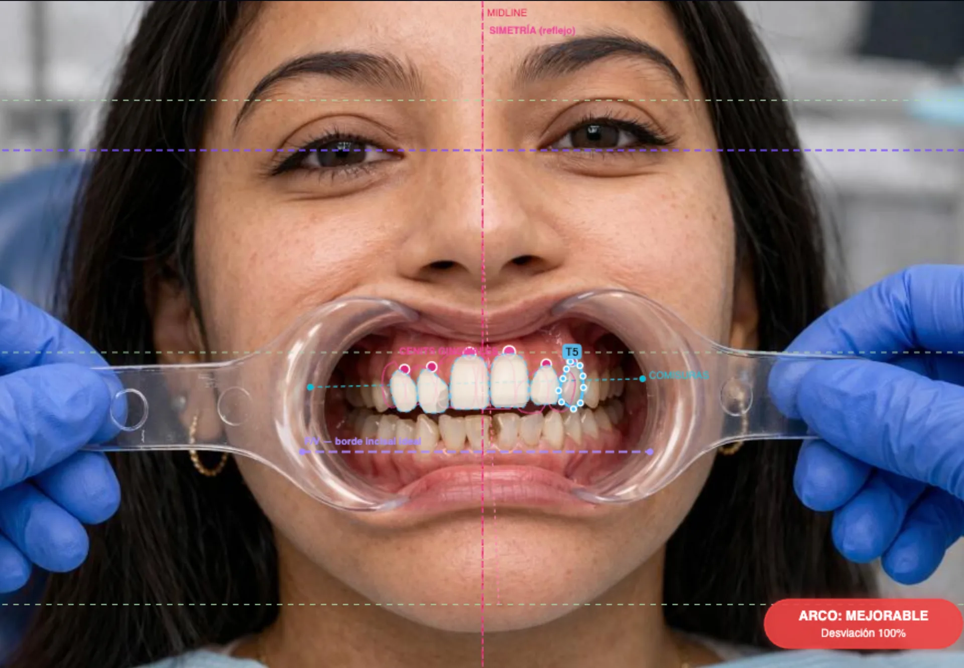 Foto de paciente con retractor y overlay de análisis TrazaSonrisa